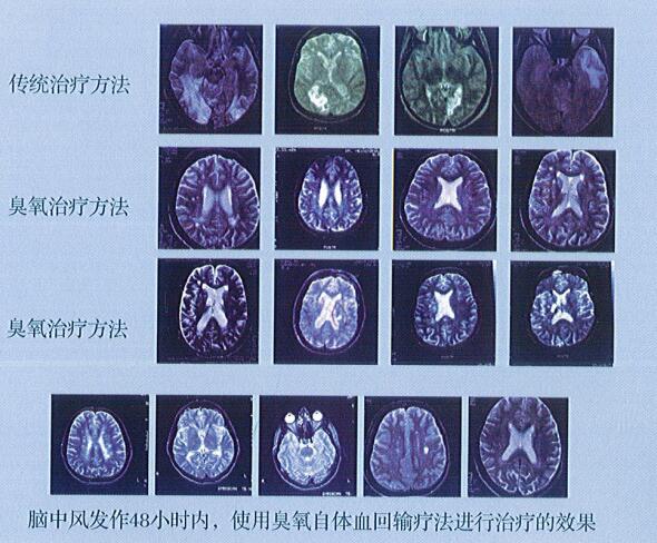 德國(guó)赫美斯臭氧治療儀